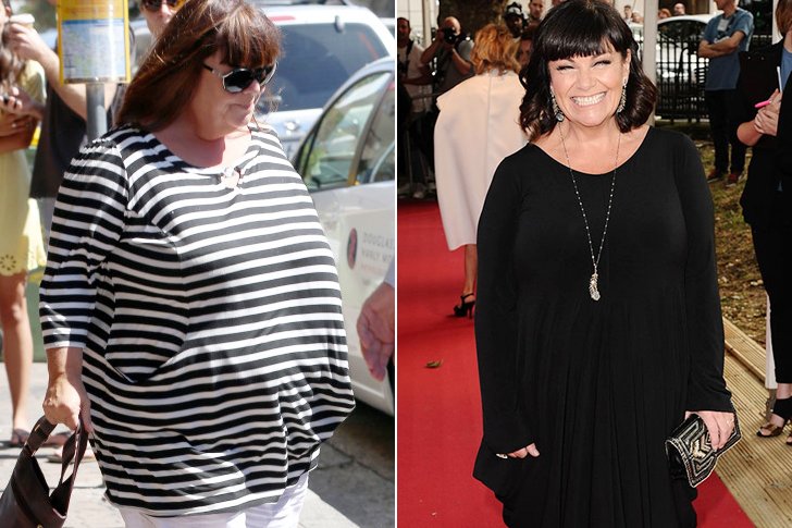 Dawn French Weight Loss Surgery Dawn Frenchs Weight Loss Was For Hysterectomy Following